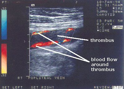 Dvt eep-venous-thrombosis-ultrasound